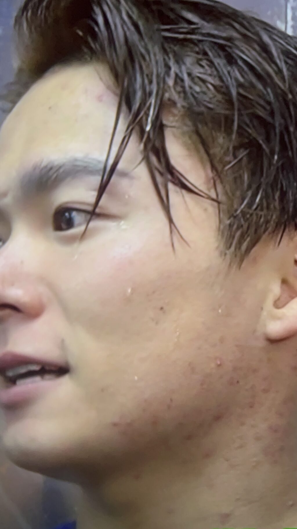 山本由伸 首湿疹