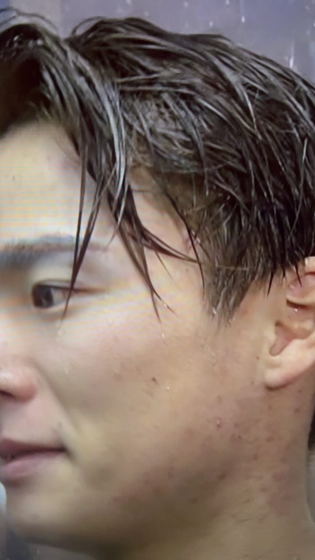 山本由伸 首湿疹